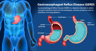 Gastroesophageal Reflux Disease Treatment Ahilyanagar