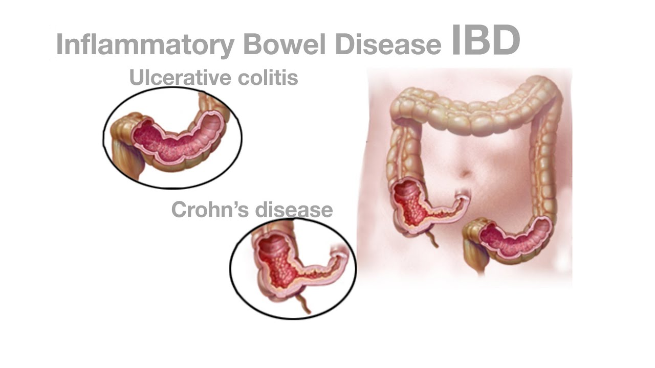 Inflammatory Bowel Disease Treatment Ahilyanagar