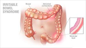 Irritable Bowel Syndrome Treatment Ahilyanagar