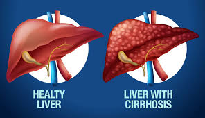 Liver Cirrhosis Treatment Ahilyanagar