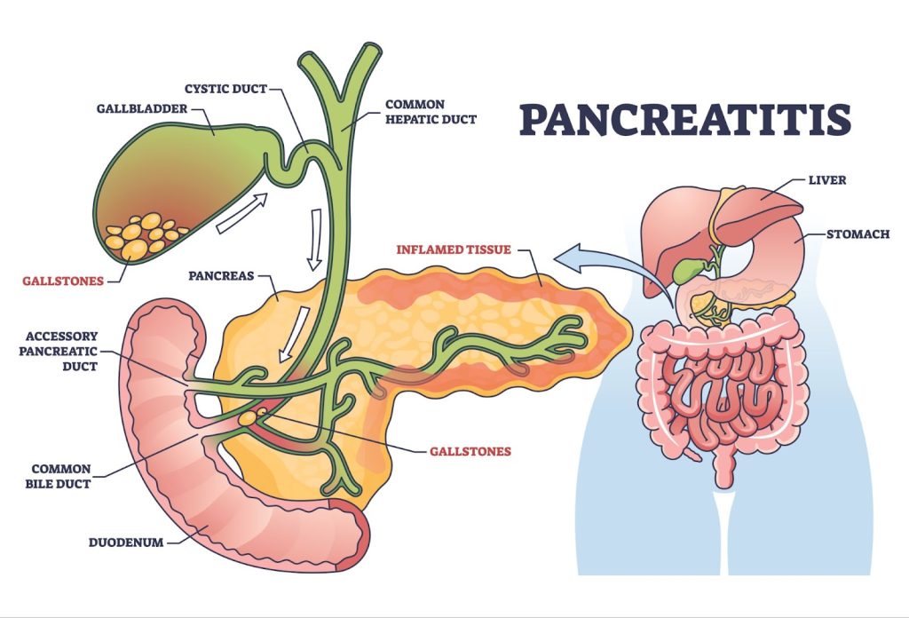Pancreatitis Treatment Ahilyanagar