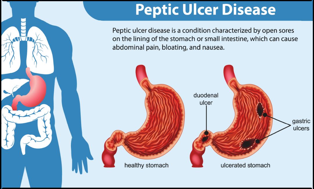 Peptic Ulcer Disease Treatment Ahilyanagar