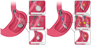 Colonoscopy Ahilyanagar